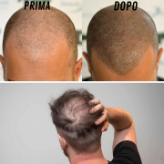 Tricopigmentazione prima e dopo